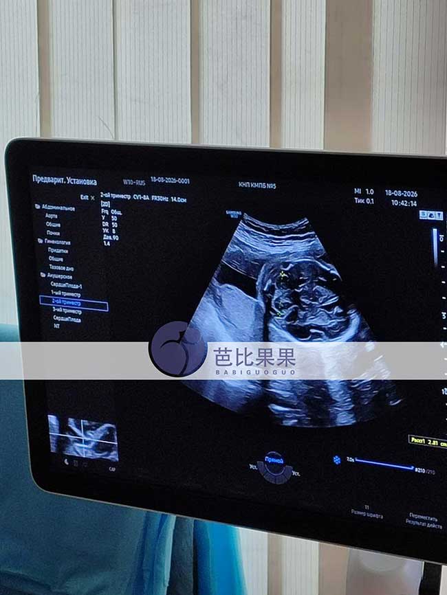 试管妈妈做B超