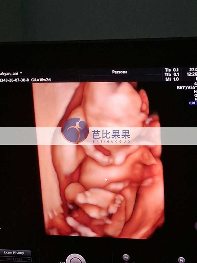 试管妈妈做B超