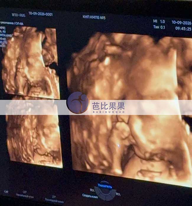 试管妈妈做四维彩超