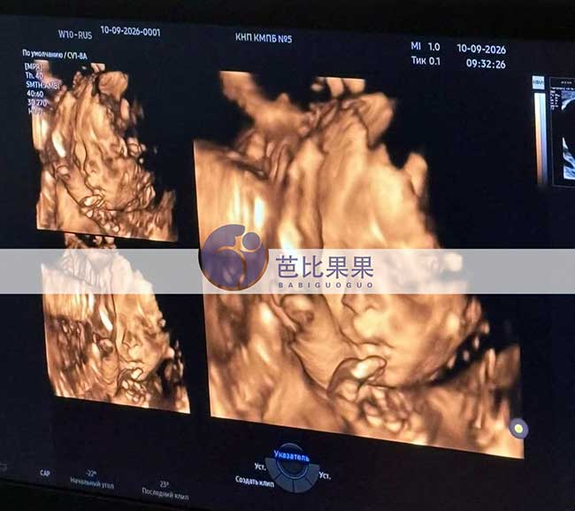 试管妈妈做四维彩超