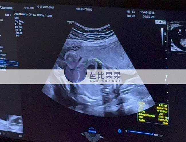 试管妈妈做四维彩超