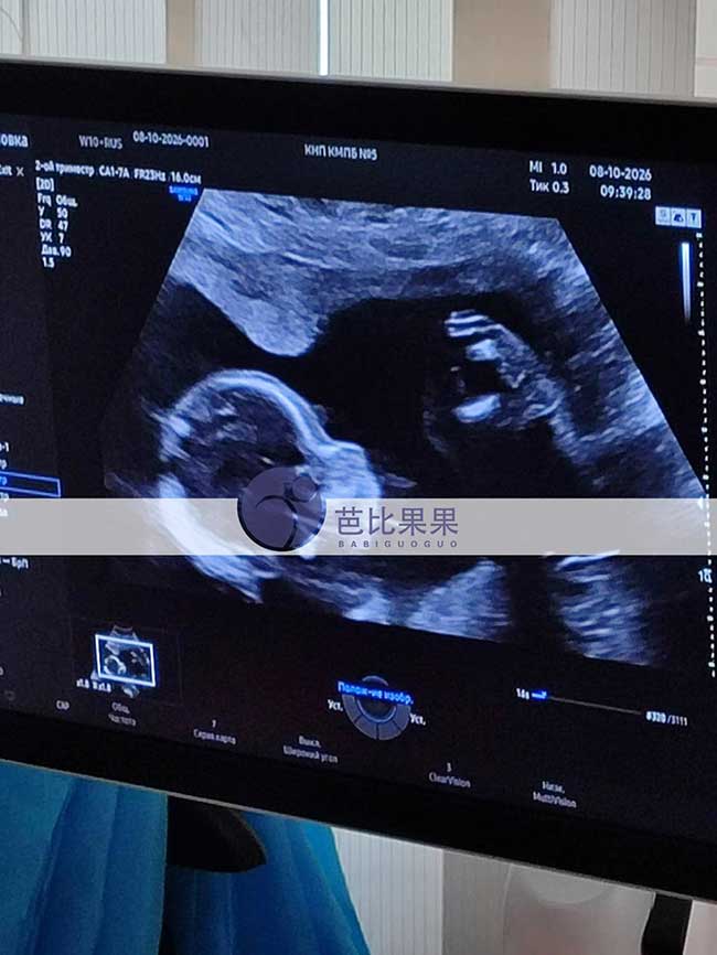 试管妈妈孕晚期B超