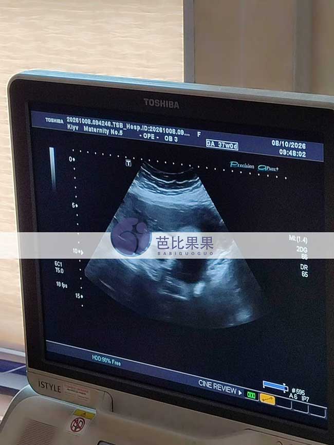 试管妈妈孕晚期B超