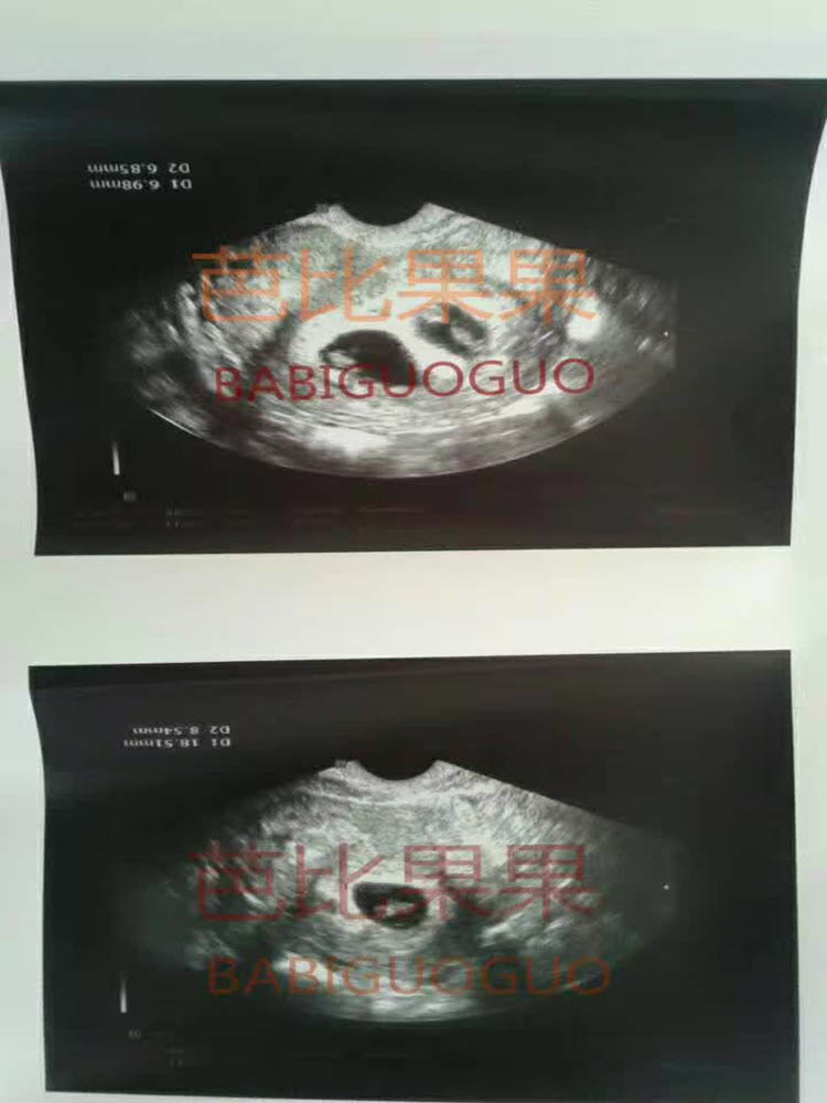 在百奥sgm的D女士首次B超 三胞胎着床了