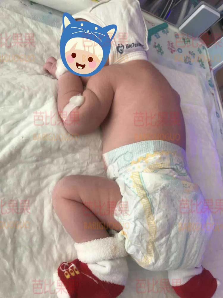 S姐的乌克兰试管助孕双胞胎公主两个都6斤多 肉嘟嘟