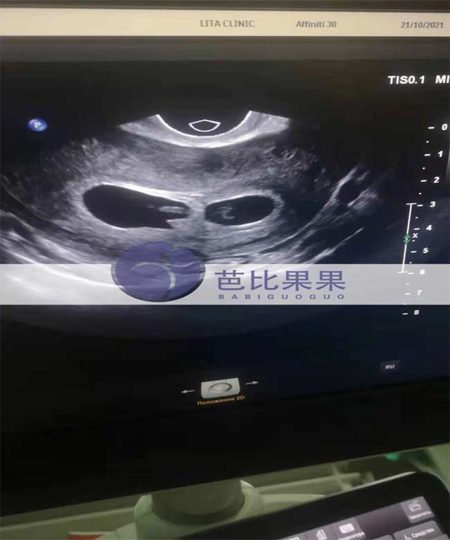 乌克兰孕妈怀上双胞胎