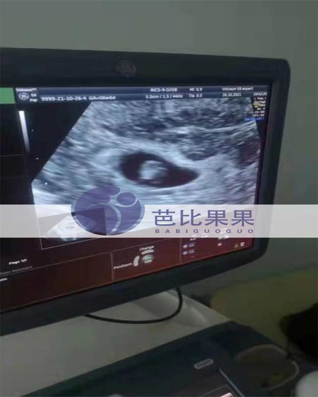 乌克兰孕妈怀上双胞胎