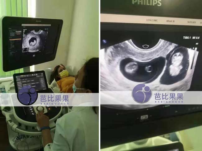 乌克兰孕妈二次B超