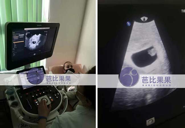 孕妈第一次B超